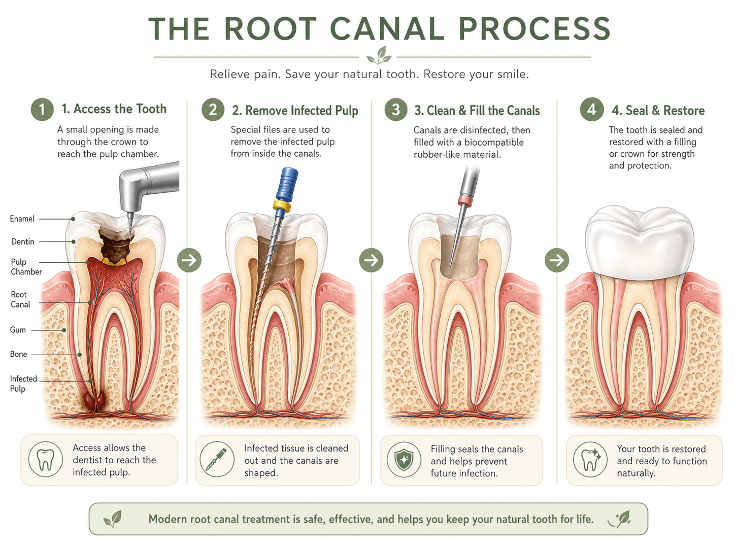 Illustrated steps of root canal therapy.